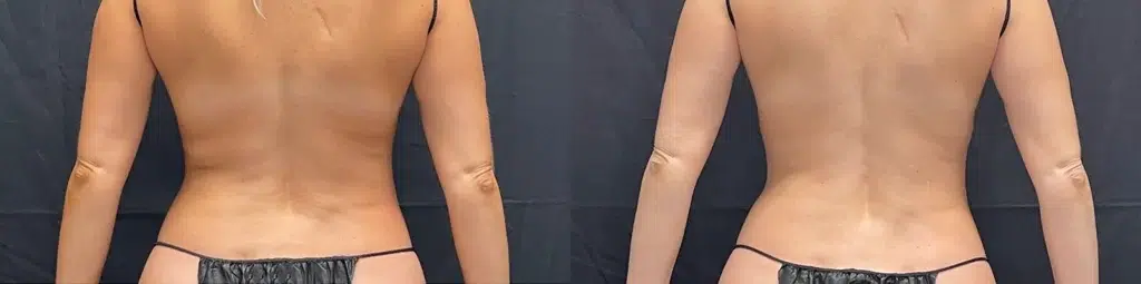 body sculpting before and after photo by georgous aesthetic bar in kansas city