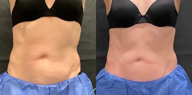 body sculpting before and after photo by georgous aesthetic bar in kansas city