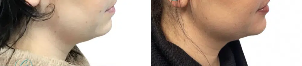 body sculpting before and after photo by georgous aesthetic bar in kansas city