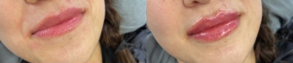 cosmetic dermal fillers before and after photo by georgous aesthetic bar in kansas city