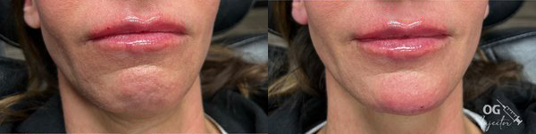 cosmetic dermal fillers before and after photo by georgous aesthetic bar in kansas city