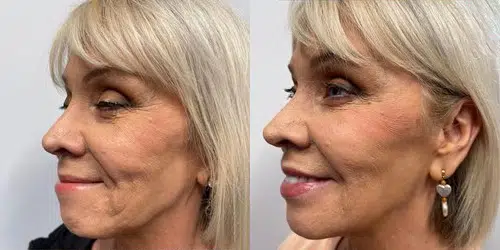 cosmetic dermal fillers before and after photo by georgous aesthetic bar in kansas city cosmetic dermal fillers before and after photo by georgous aesthetic bar in kansas city