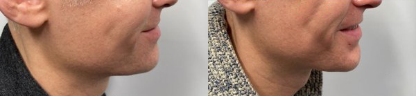 cosmetic dermal fillers before and after photo by georgous aesthetic bar in kansas city