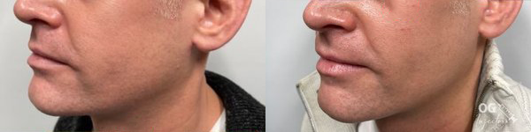 cosmetic dermal fillers before and after photo by georgous aesthetic bar in kansas city