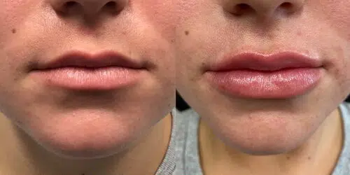 cosmetic dermal fillers before and after photo by georgous aesthetic bar in kansas city cosmetic dermal fillers before and after photo by georgous aesthetic bar in kansas city