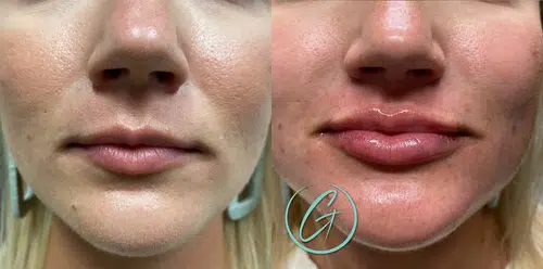 cosmetic dermal fillers before and after photo by georgous aesthetic bar in kansas city cosmetic dermal fillers before and after photo by georgous aesthetic bar in kansas city
