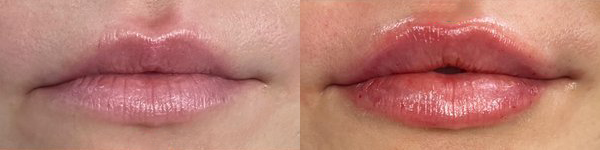 cosmetic dermal fillers before and after photo by georgous aesthetic bar in kansas city