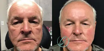 cosmetic dermal fillers before and after photo by georgous aesthetic bar in kansas city cosmetic dermal fillers before and after photo by georgous aesthetic bar in kansas city