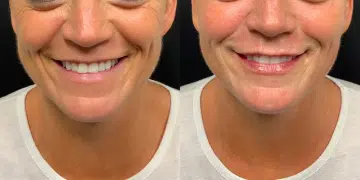 cosmetic dermal fillers before and after photo by georgous aesthetic bar in kansas city cosmetic dermal fillers before and after photo by georgous aesthetic bar in kansas city
