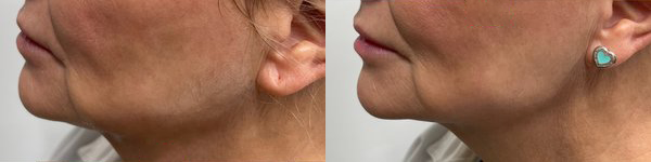 cosmetic dermal fillers before and after photo by georgous aesthetic bar in kansas city