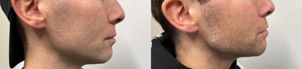 cosmetic dermal fillers before and after photo by georgous aesthetic bar in kansas city