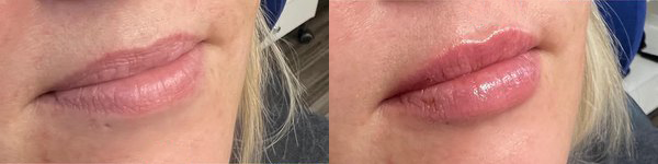 cosmetic dermal fillers before and after photo by georgous aesthetic bar in kansas city