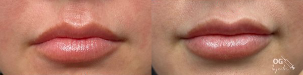 cosmetic dermal fillers before and after photo by georgous aesthetic bar in kansas city