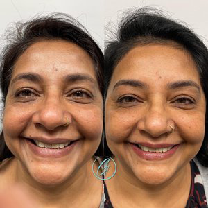 cosmetic dermal fillers before and after photo by georgous aesthetic bar in kansas city
