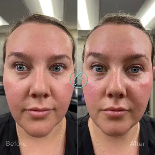 facials before and after photo by georgous aesthetic bar in kansas city