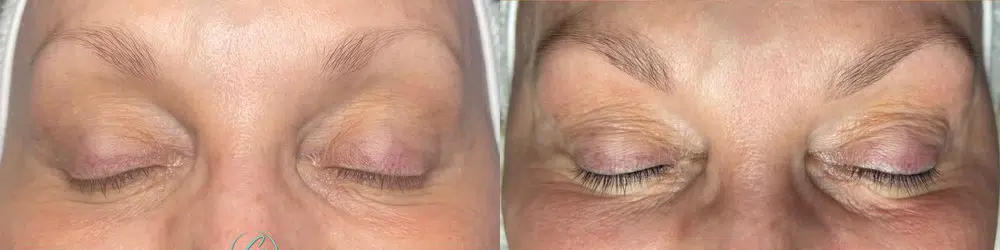 facials before and after photo by georgous aesthetic bar in kansas city