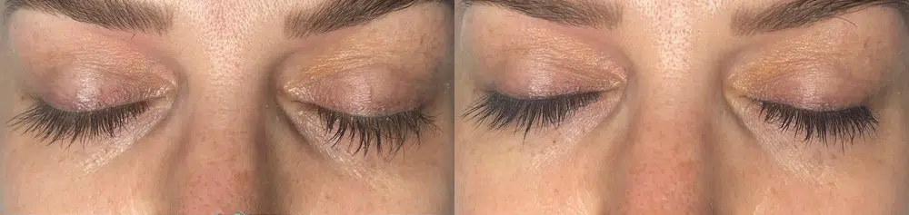 facials before and after photo by georgous aesthetic bar in kansas city