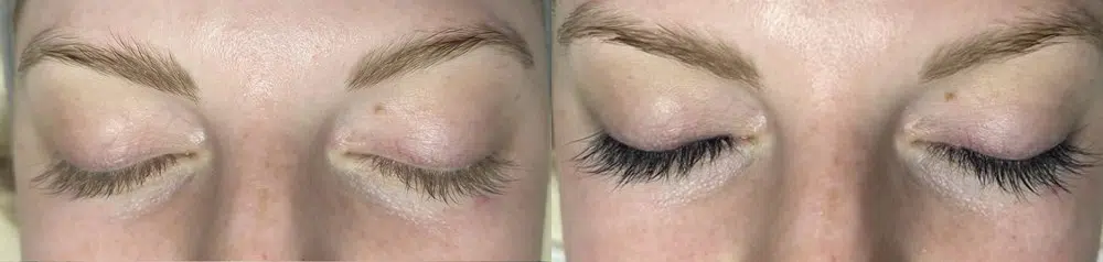 facials before and after photo by georgous aesthetic bar in kansas city