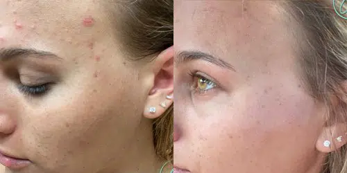 facials before and after photo by georgous aesthetic bar in kansas city