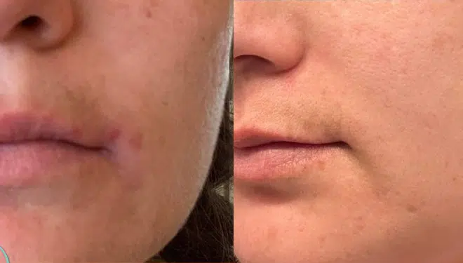 facials before and after photo by georgous aesthetic bar in kansas city