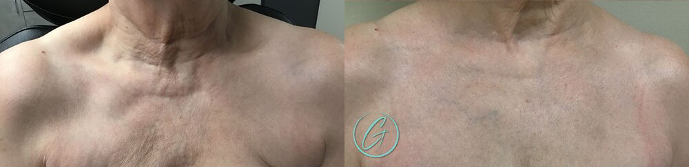 texture tone before and after photo by georgous aesthetic bar in kansas city