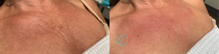 texture tone before and after photo by georgous aesthetic bar in kansas city