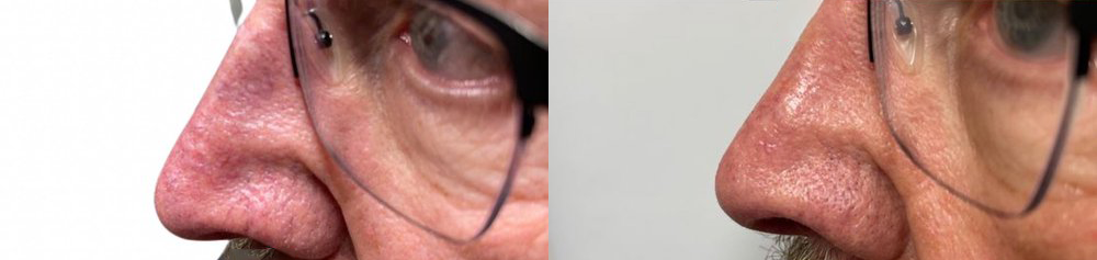 texture tone before and after photo by georgous aesthetic bar in kansas city