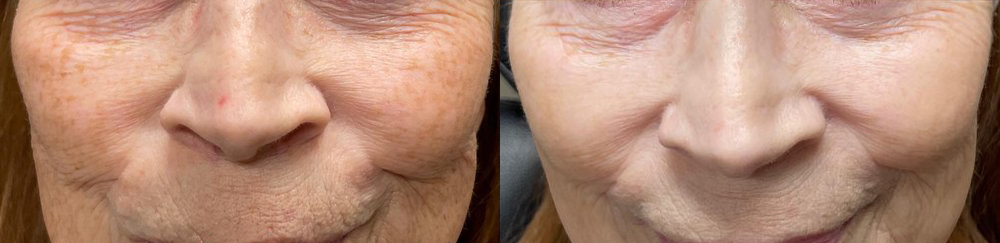 texture tone before and after photo by georgous aesthetic bar in kansas city
