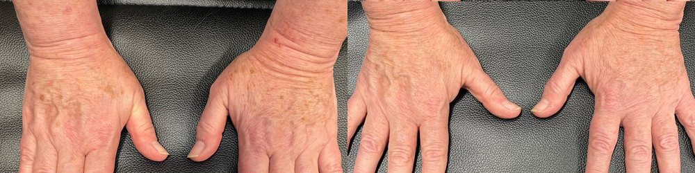 texture tone before and after photo by georgous aesthetic bar in kansas city