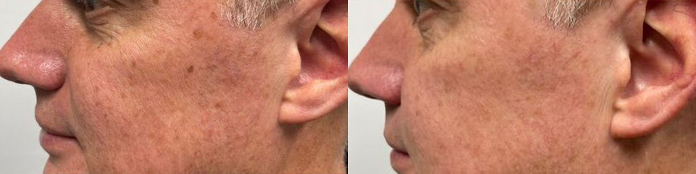 texture tone before and after photo by georgous aesthetic bar in kansas city