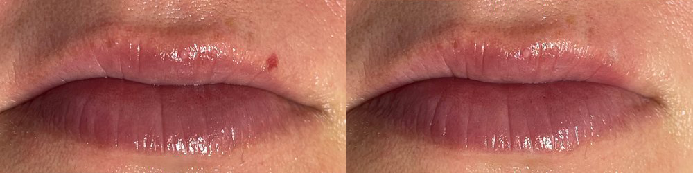 texture tone before and after photo by georgous aesthetic bar in kansas city