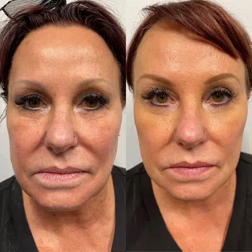 thread lifts before and after photo by georgous aesthetic bar in kansas city
