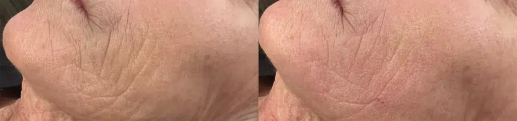 thread lifts before and after photo by georgous aesthetic bar in kansas city