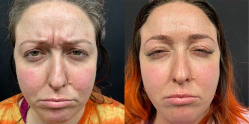 wrinkle relaxers before and after photo by georgous aesthetic bar in kansas city