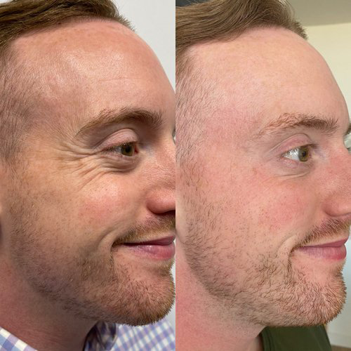 wrinkle relaxers before and after photo by georgous aesthetic bar in kansas city