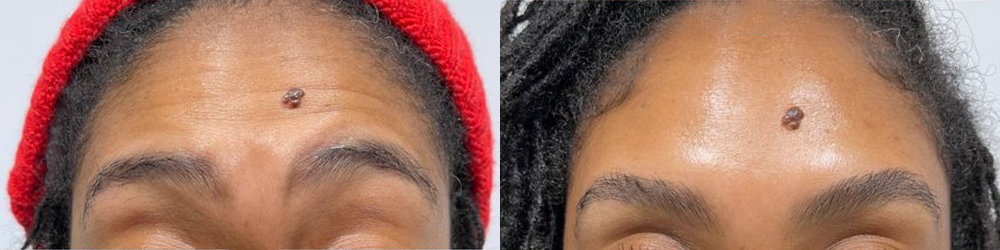 wrinkle relaxers before and after photo by georgous aesthetic bar in kansas city