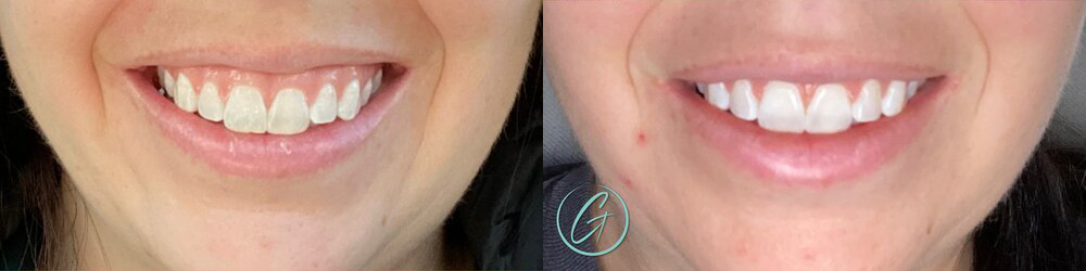 wrinkle relaxers before and after photo by georgous aesthetic bar in kansas city