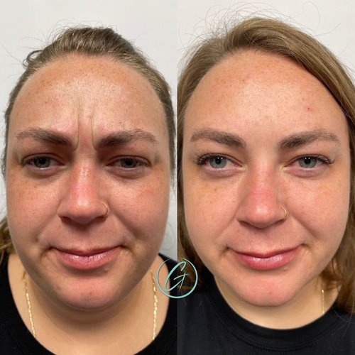 wrinkle relaxers before and after photo by georgous aesthetic bar in kansas city
