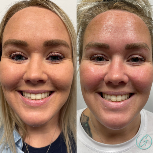 wrinkle relaxers before and after photo by georgous aesthetic bar in kansas city