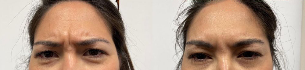 wrinkle relaxers before and after photo by georgous aesthetic bar in kansas city