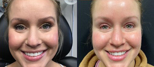 wrinkle relaxers before and after photo by georgous aesthetic bar in kansas city