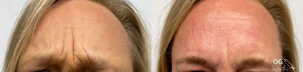 wrinkle relaxers before and after photo by georgous aesthetic bar in kansas city