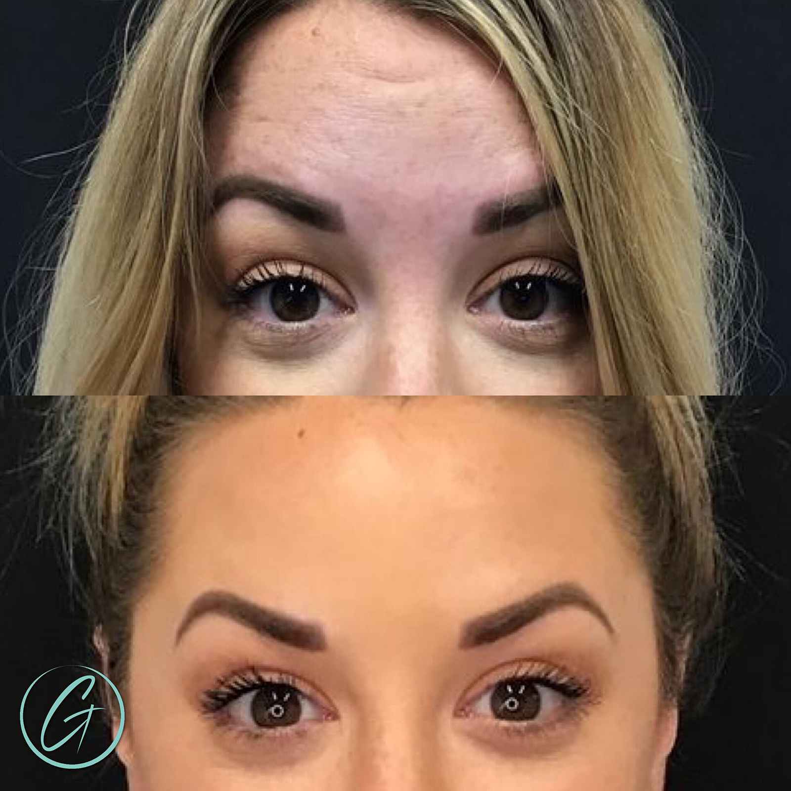 georgous before after botox forehead