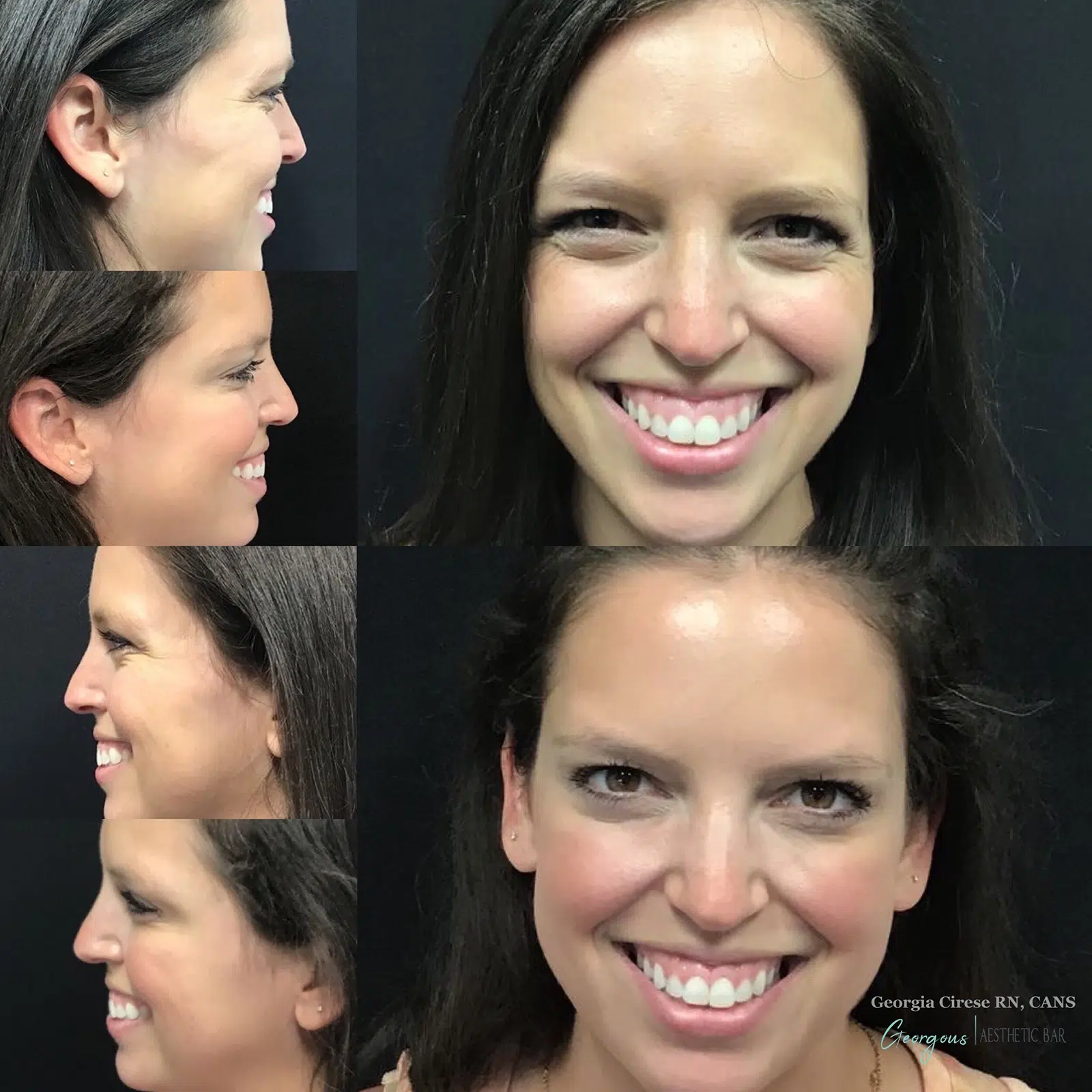 georgous before after botox