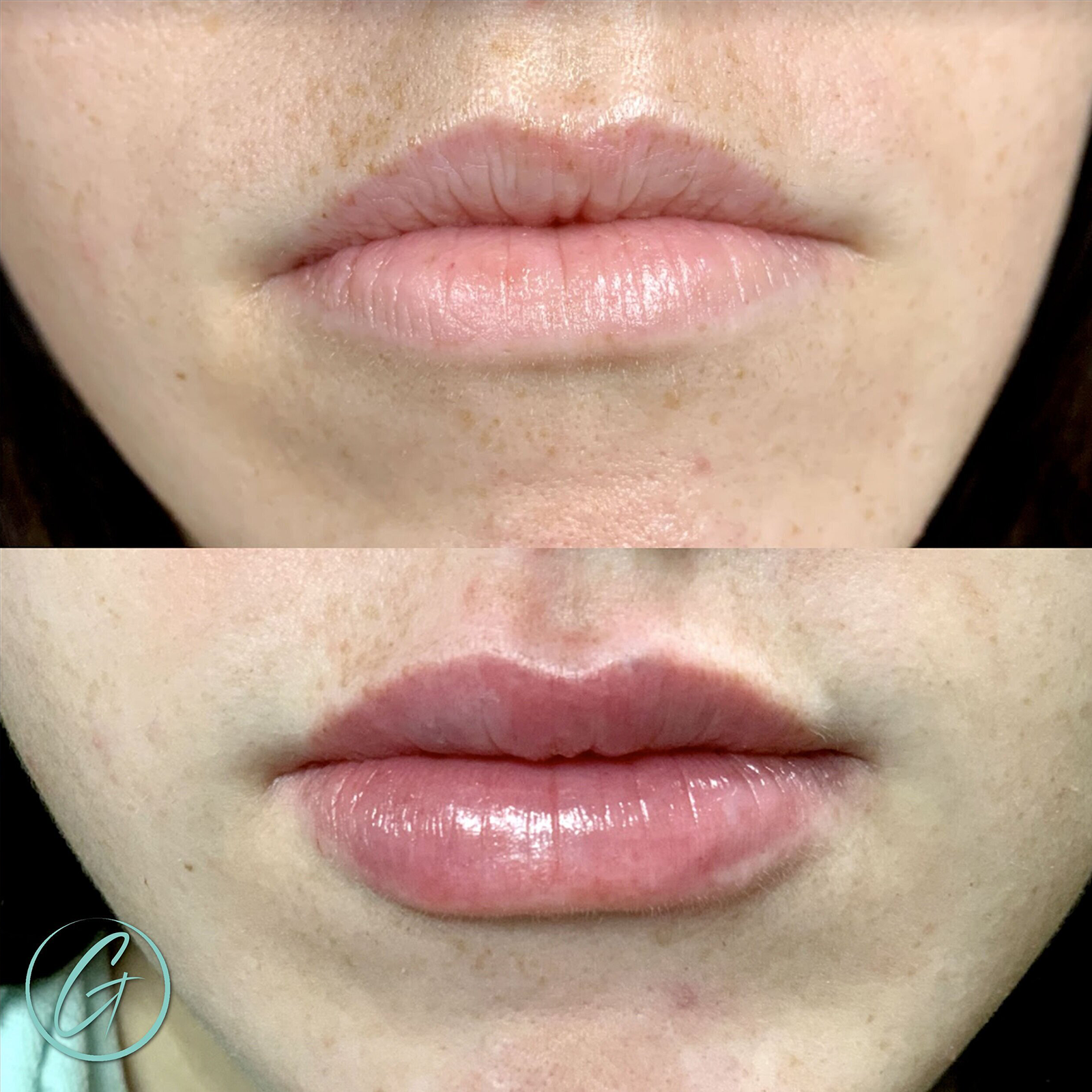 georgous juvederm before after