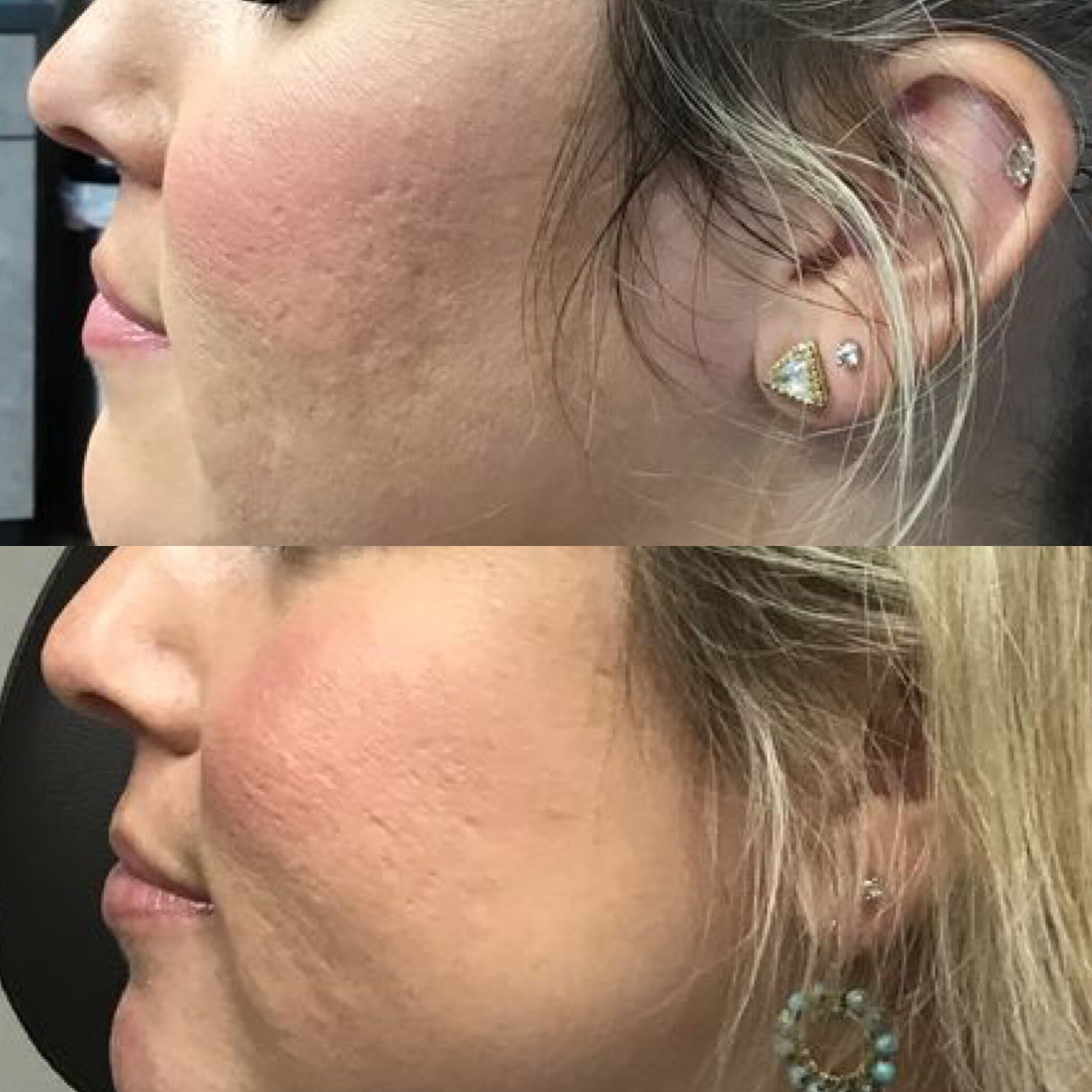 microneedling before and after photo