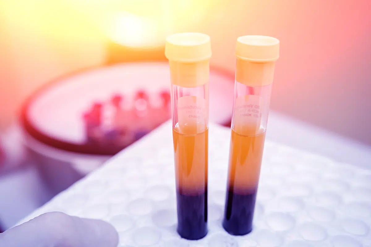 platelet rich plasma preparation tube centrifuge